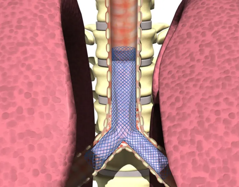 Airway Stenting
