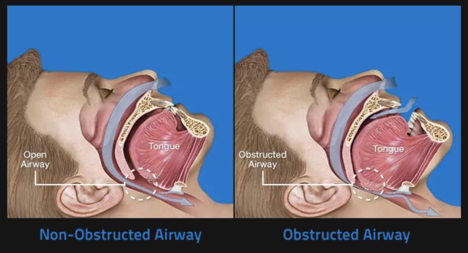 Obstructive sleep apnea illustration