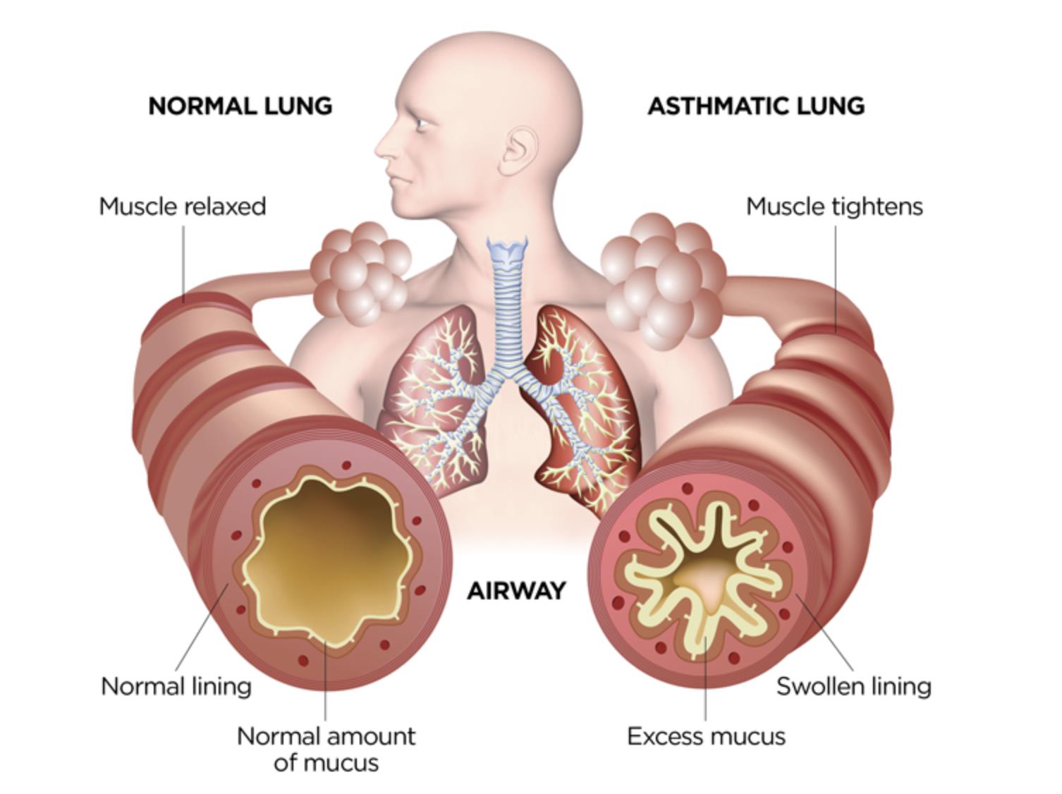 Asthma treatment in Nagpur by Dr. Sameer Arbat