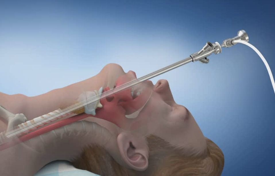 Rigid bronchoscopy procedure by Dr. Sameer Arbat, Nagpur